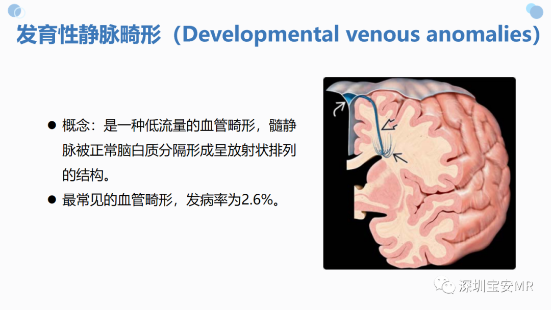 影像PPT - 【PPT】中枢神经系统血管畸形-20