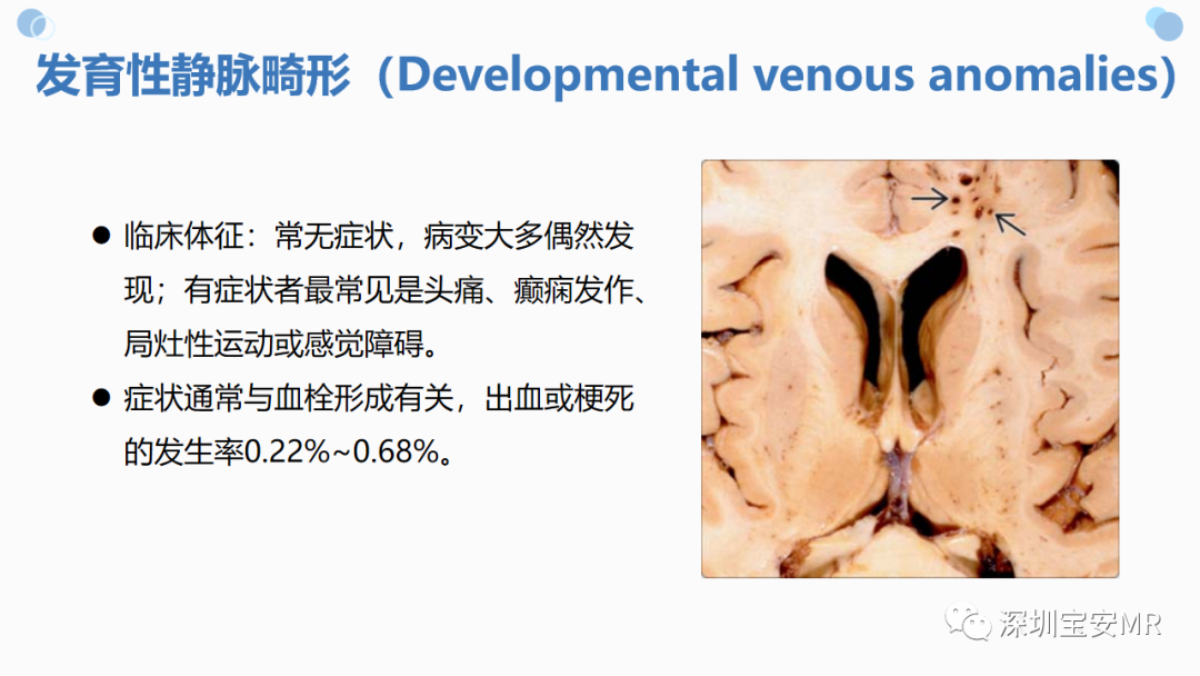 影像PPT - 【PPT】中枢神经系统血管畸形-21