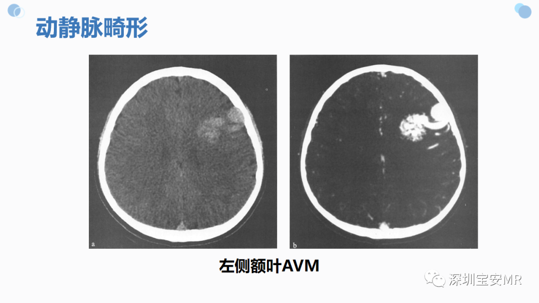 影像PPT - 【PPT】中枢神经系统血管畸形-9