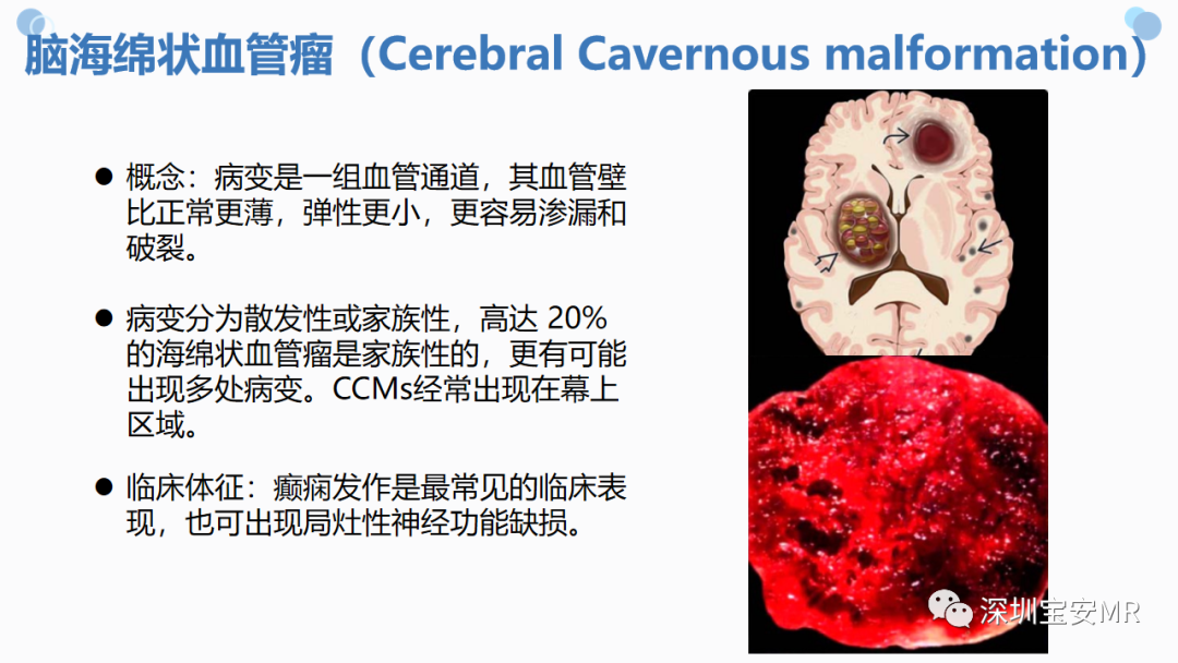影像PPT - 【PPT】中枢神经系统血管畸形-15