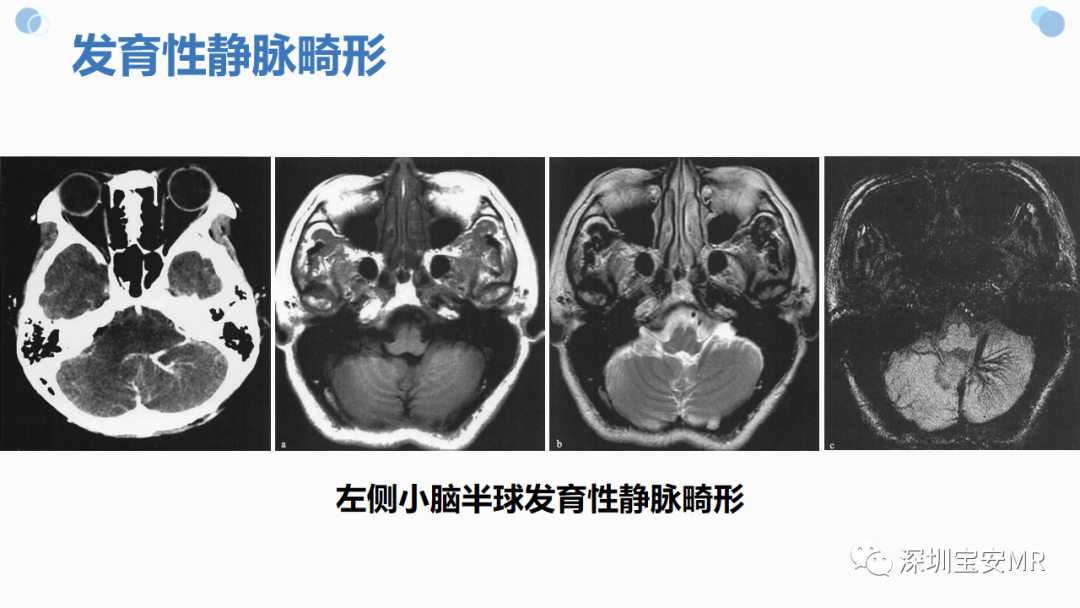 影像PPT - 【PPT】中枢神经系统血管畸形-23
