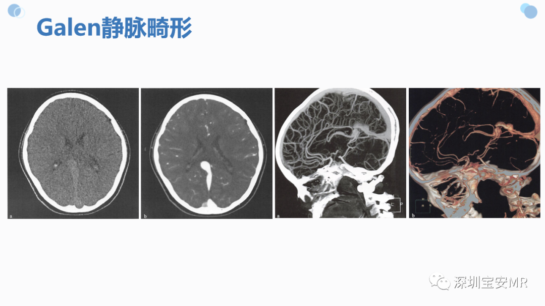 影像PPT - 【PPT】中枢神经系统血管畸形-28