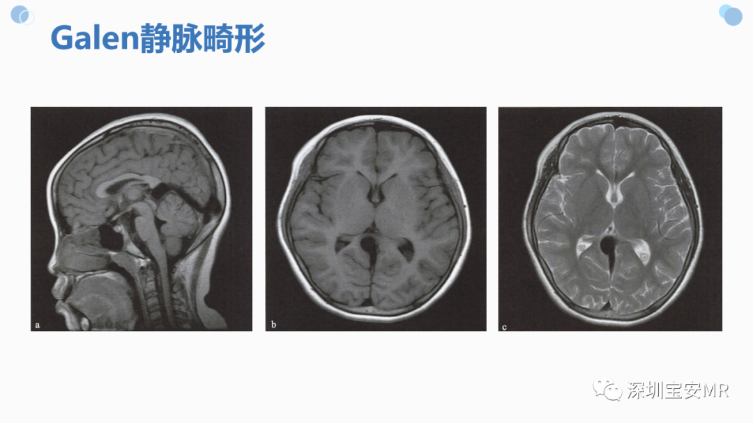 影像PPT - 【PPT】中枢神经系统血管畸形-29