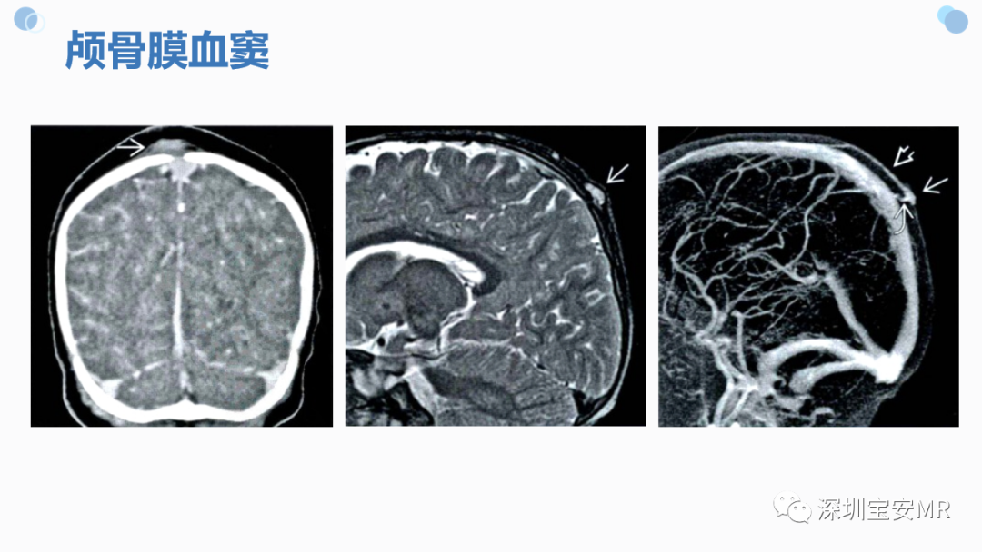 影像PPT - 【PPT】中枢神经系统血管畸形-32