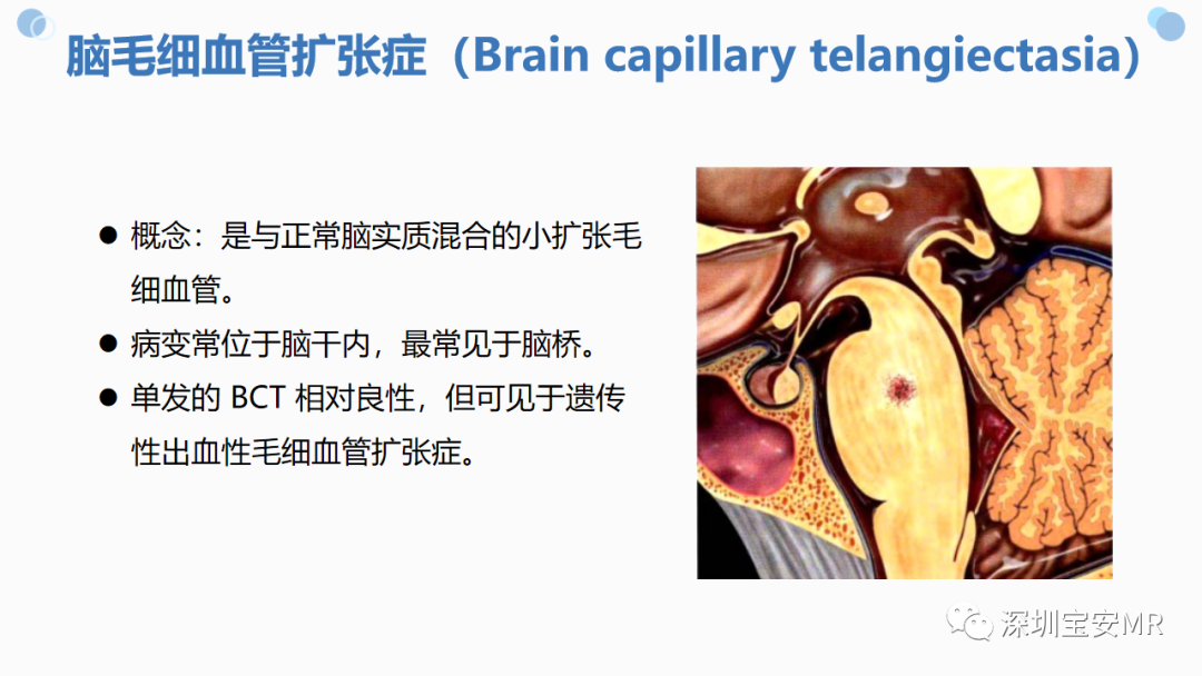 影像PPT - 【PPT】中枢神经系统血管畸形-34