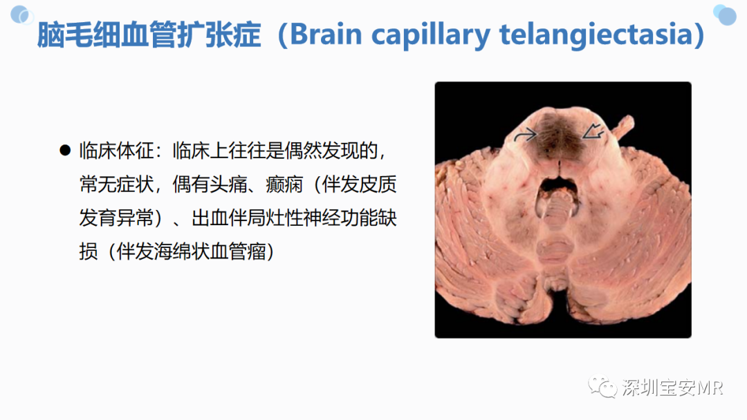 影像PPT - 【PPT】中枢神经系统血管畸形-35