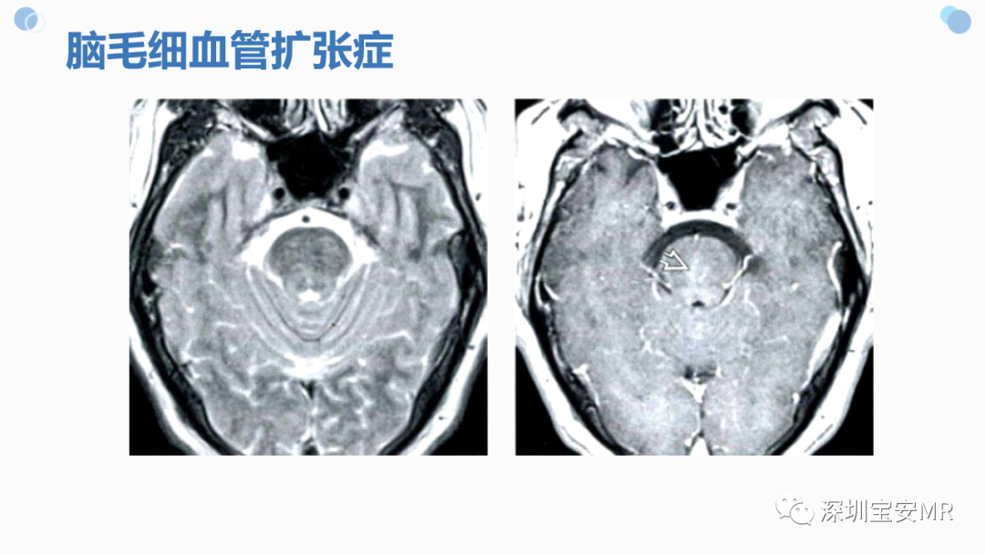 影像PPT - 【PPT】中枢神经系统血管畸形-37