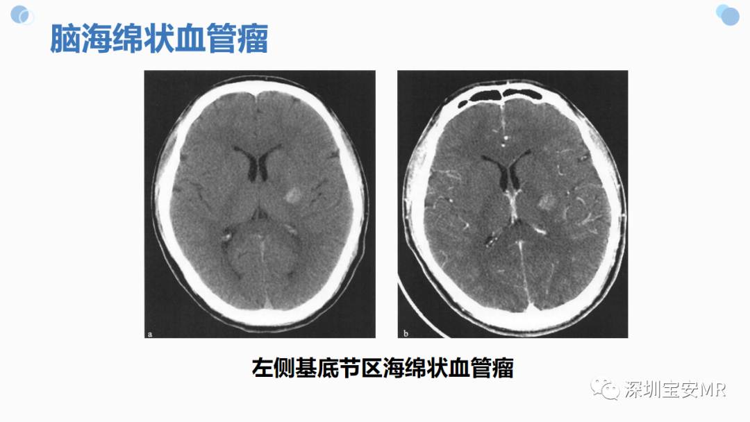 影像PPT - 【PPT】中枢神经系统血管畸形-1