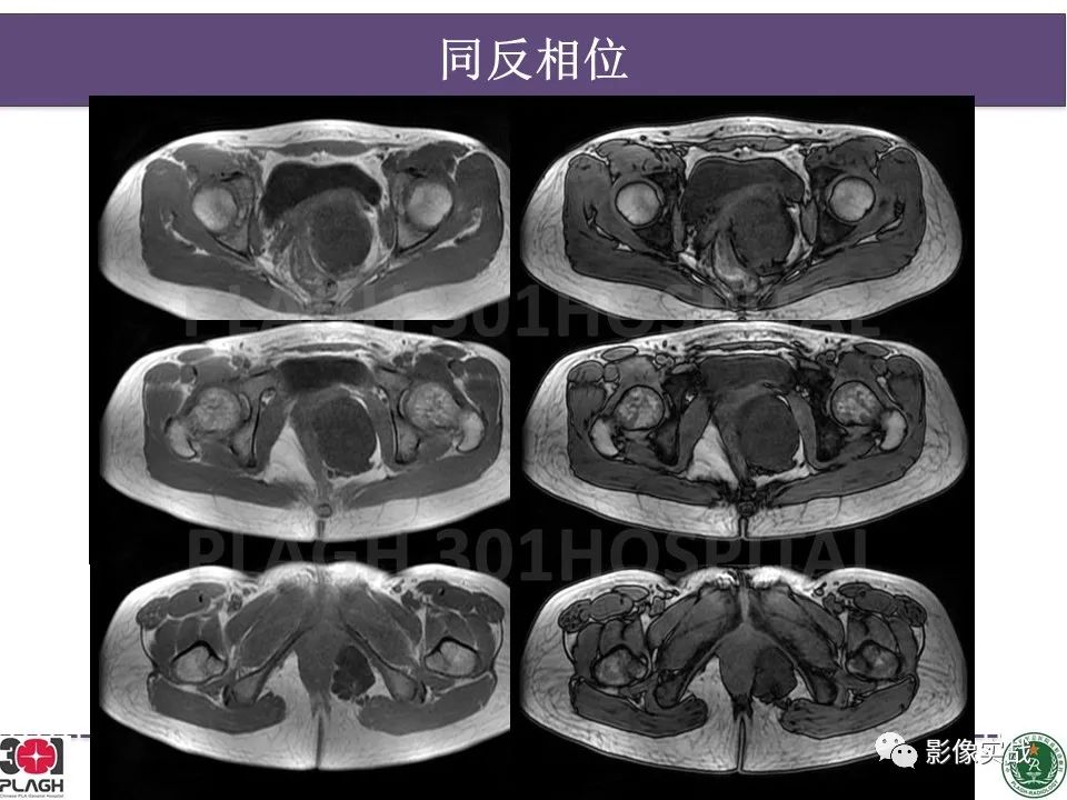 影像PPT - 【病例】侵袭性血管粘液瘤1例CT及MR-7