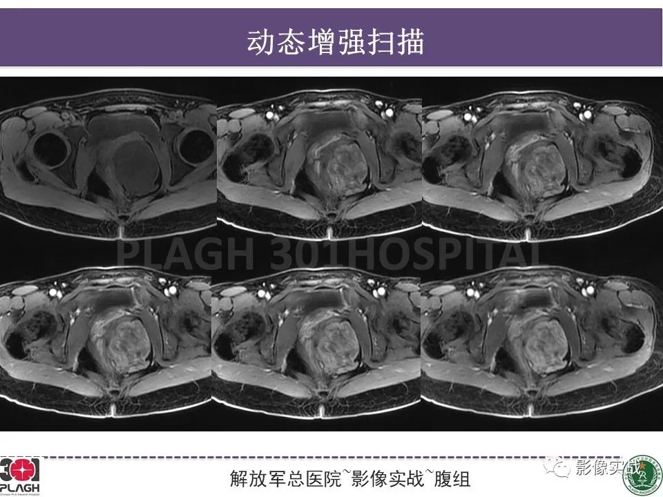 影像PPT - 【病例】侵袭性血管粘液瘤1例CT及MR-11