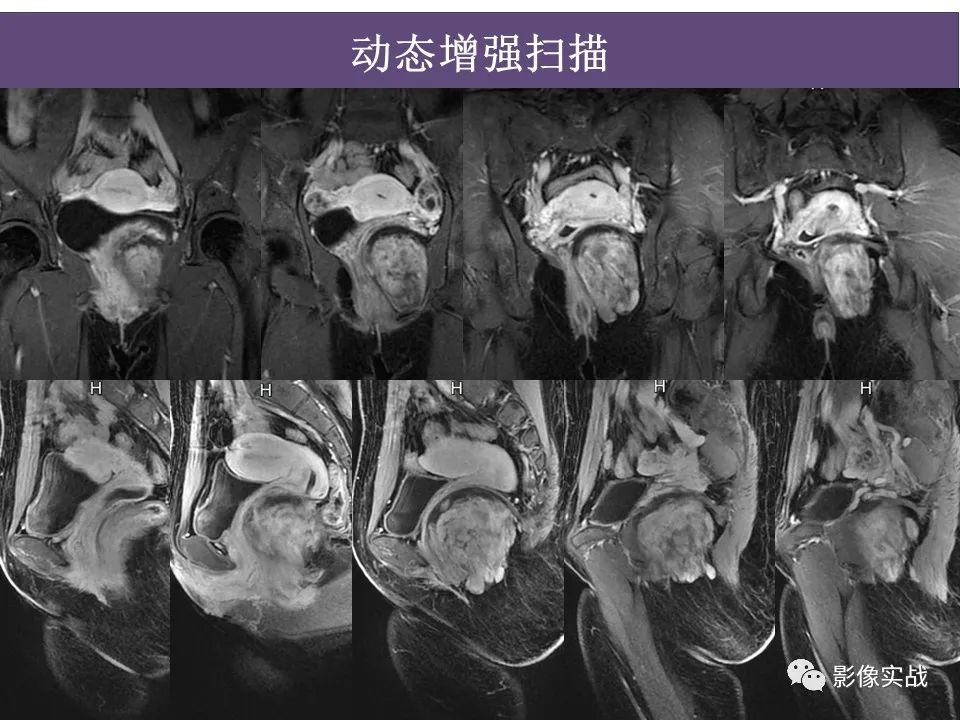 影像PPT - 【病例】侵袭性血管粘液瘤1例CT及MR-13