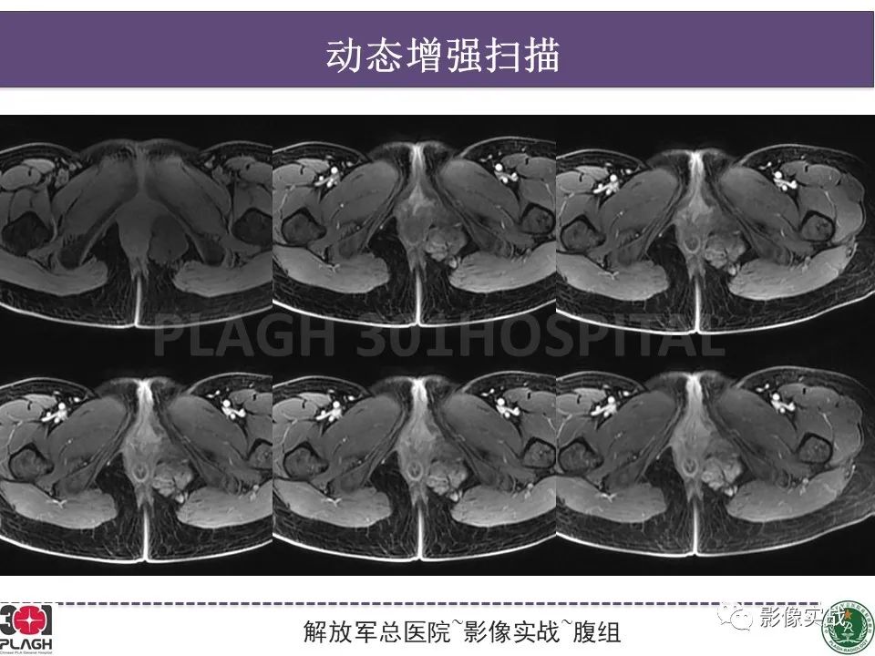 影像PPT - 【病例】侵袭性血管粘液瘤1例CT及MR-12