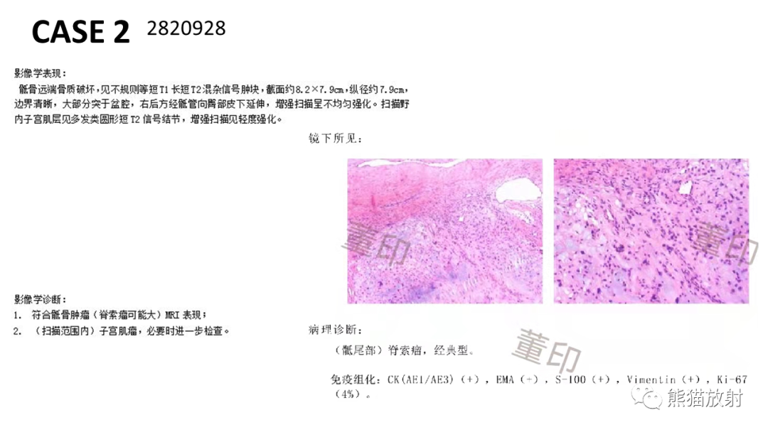 影像PPT - 【病例】斜坡 & 骶骨脊索瘤各1例CT及MR-9