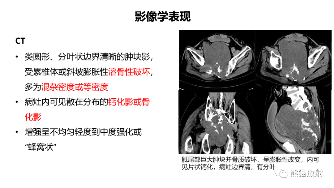 影像PPT - 【病例】斜坡 & 骶骨脊索瘤各1例CT及MR-13