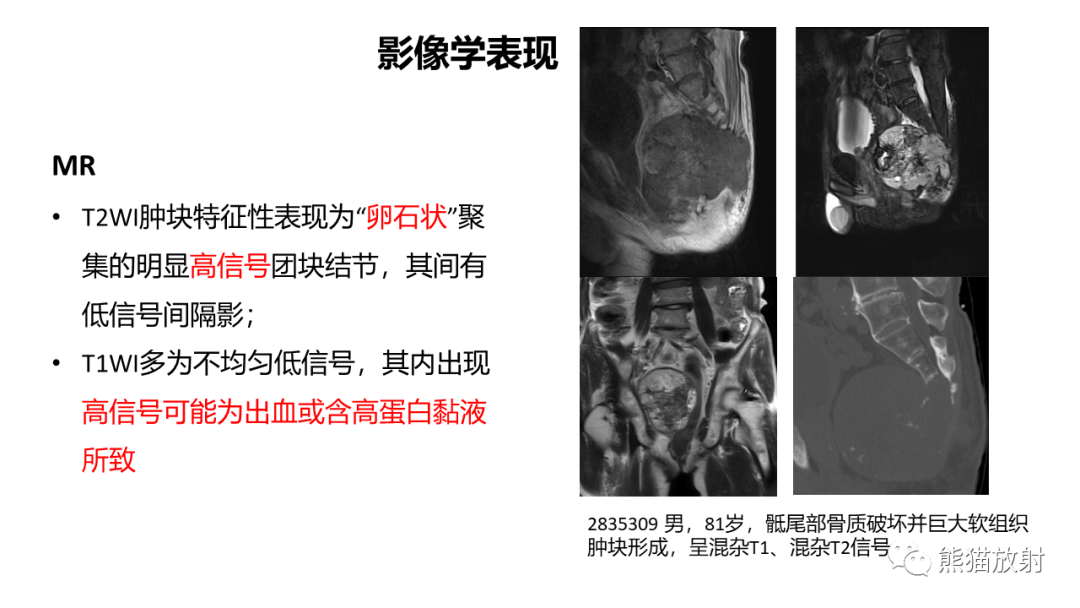影像PPT - 【病例】斜坡 & 骶骨脊索瘤各1例CT及MR-14