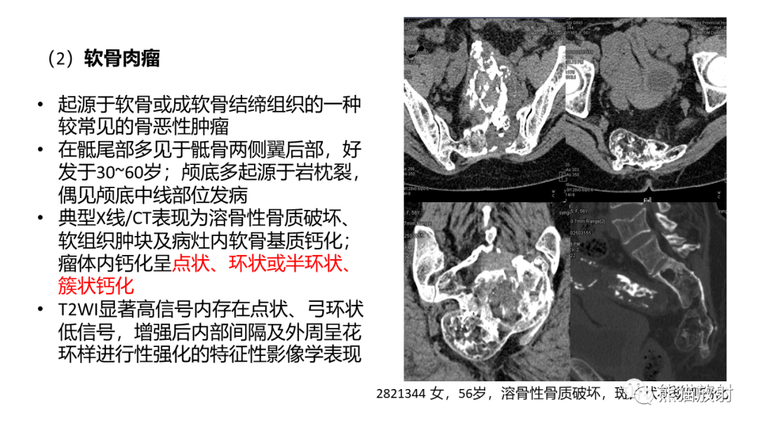 影像PPT - 【病例】斜坡 & 骶骨脊索瘤各1例CT及MR-18