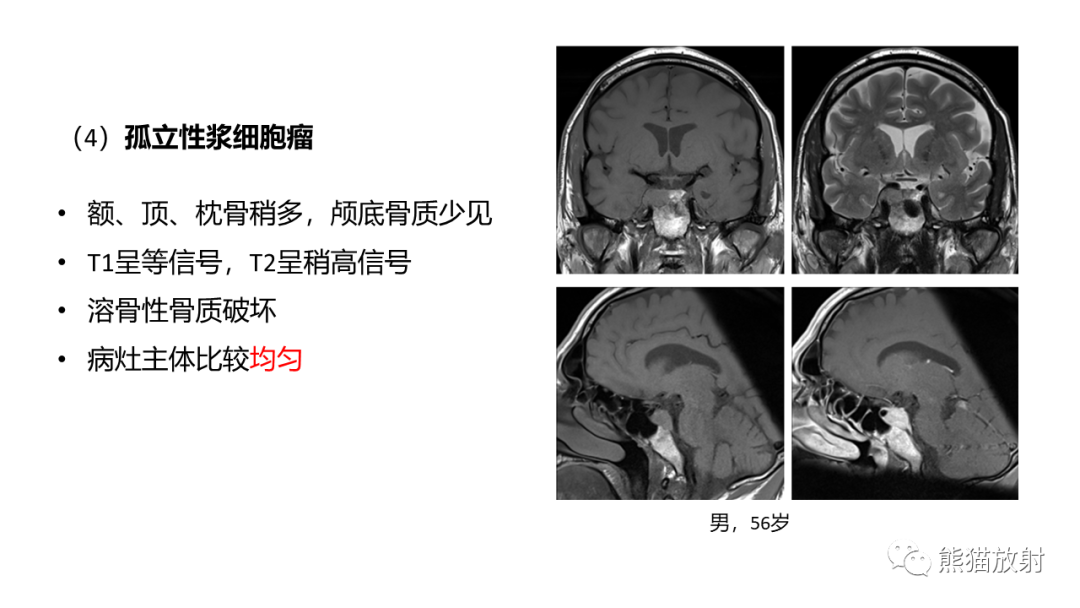 影像PPT - 【病例】斜坡 & 骶骨脊索瘤各1例CT及MR-20