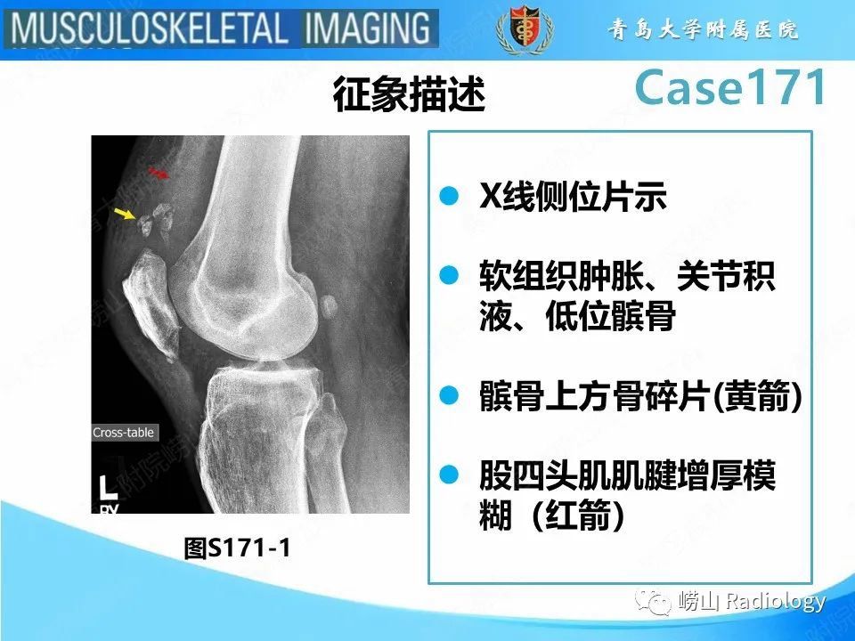 影像PPT - 【PPT】股四头肌肌腱断裂-16