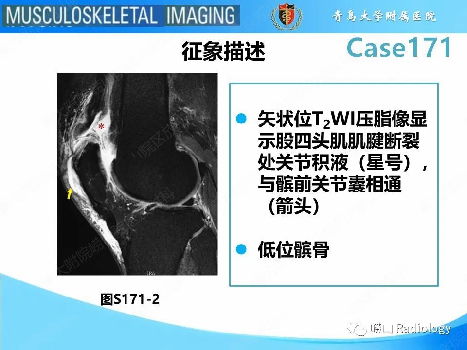 影像PPT - 【PPT】股四头肌肌腱断裂-17