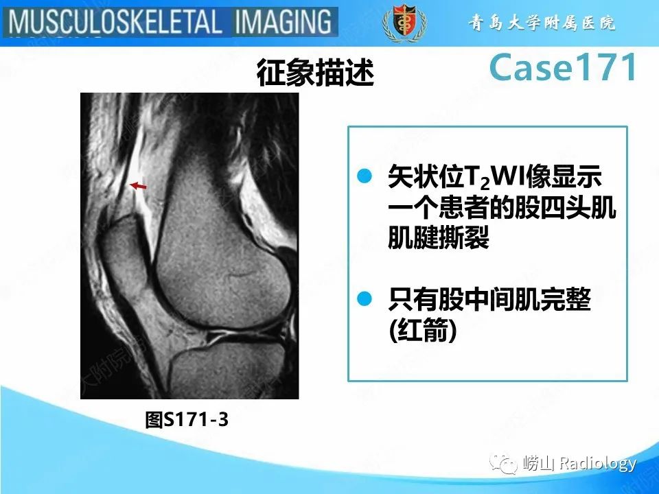 影像PPT - 【PPT】股四头肌肌腱断裂-18