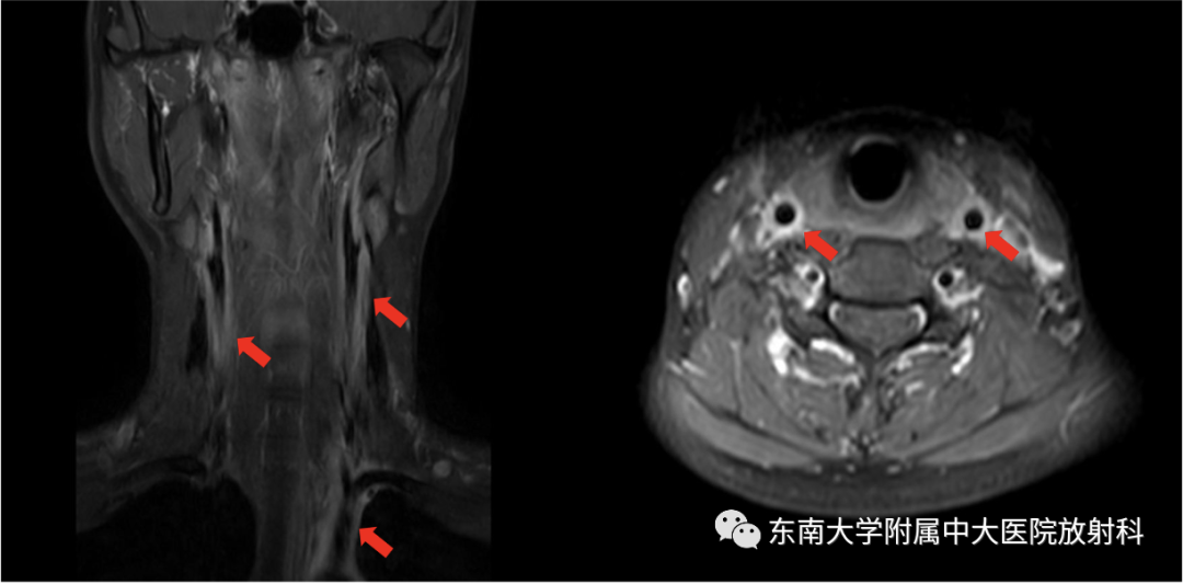 影像PPT - 【PPT】多发性大动脉炎-1
