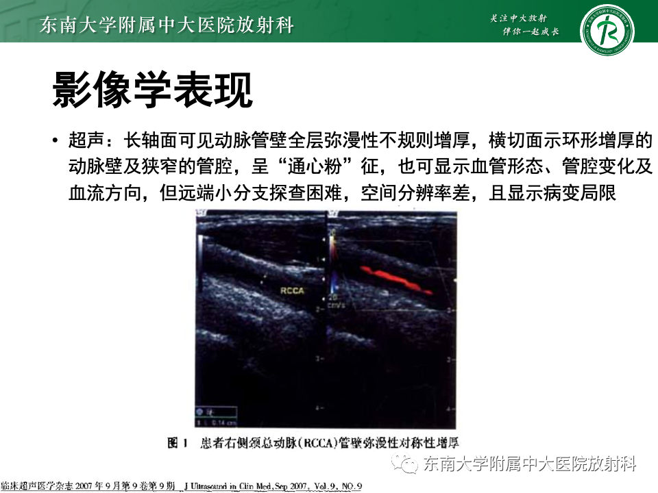 影像PPT - 【PPT】多发性大动脉炎-18