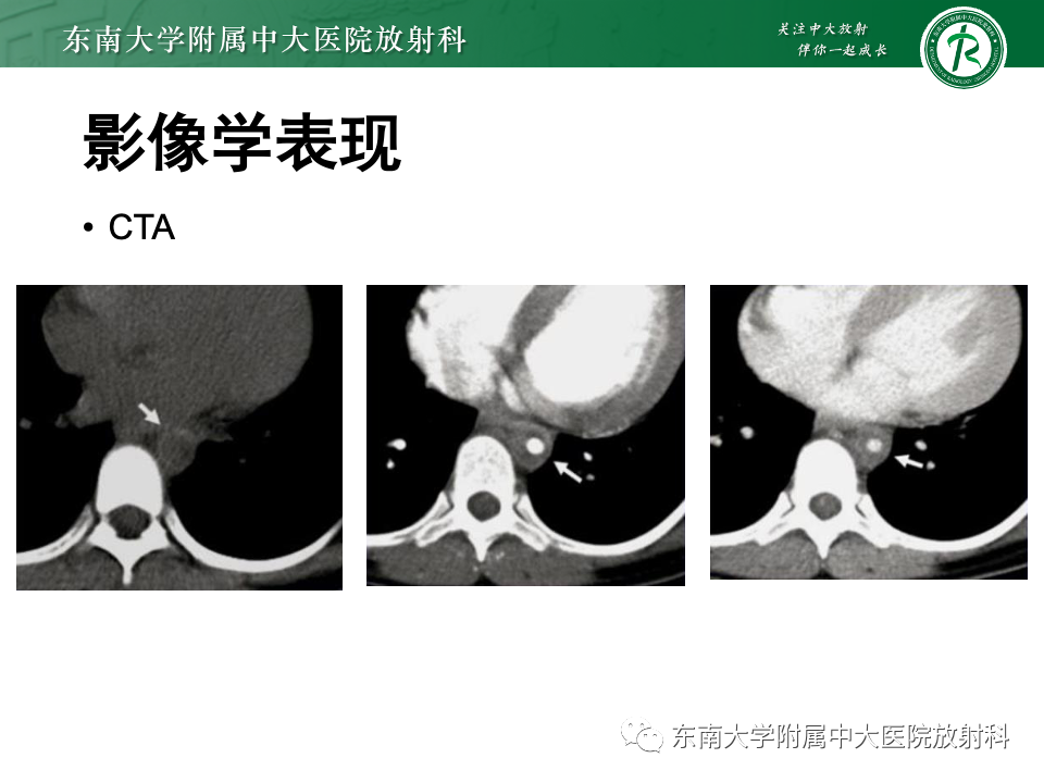 影像PPT - 【PPT】多发性大动脉炎-20