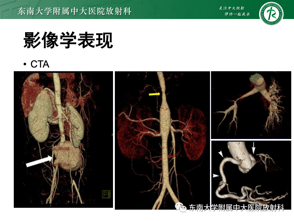 影像PPT - 【PPT】多发性大动脉炎-21