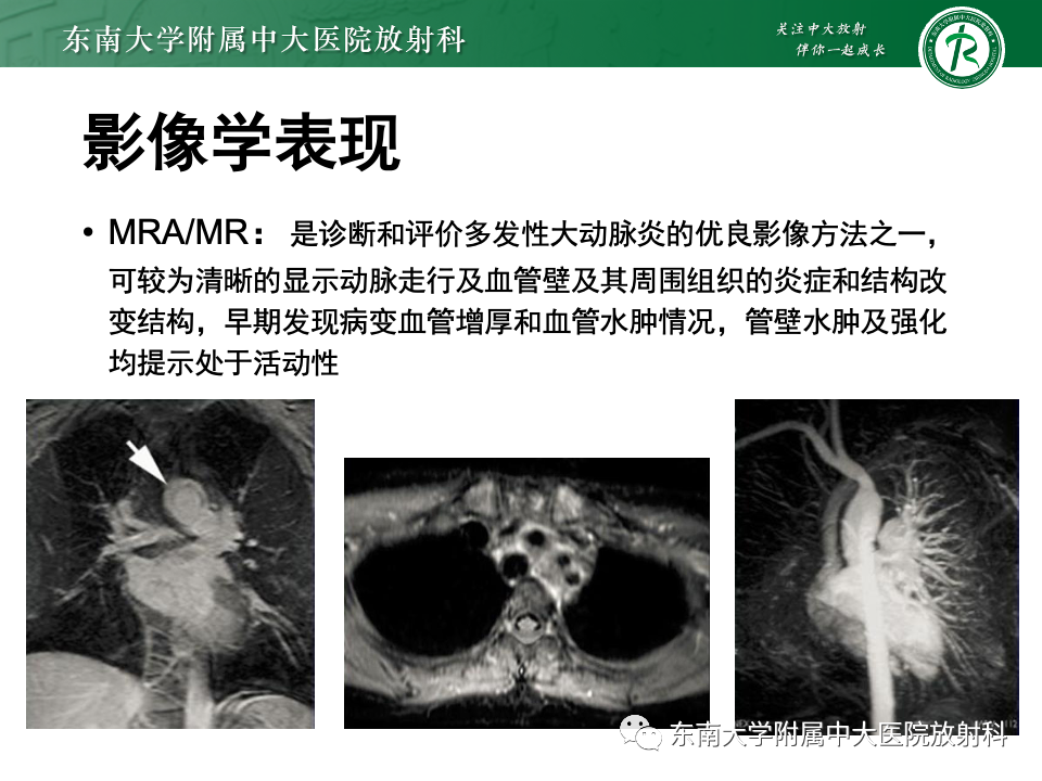 影像PPT - 【PPT】多发性大动脉炎-22