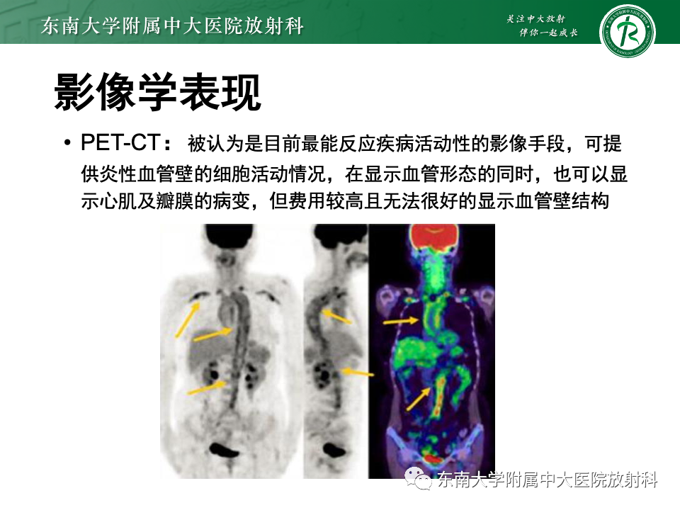 影像PPT - 【PPT】多发性大动脉炎-23