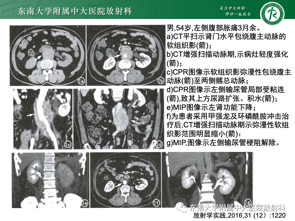 影像PPT - 【PPT】多发性大动脉炎-30