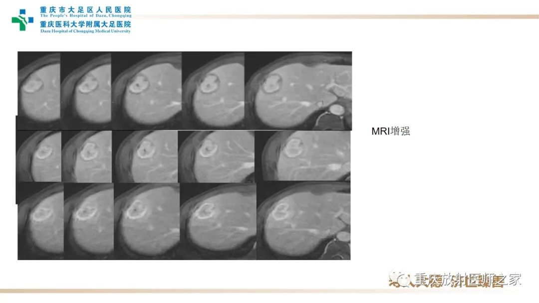 影像PPT - 【病例】肝脏炎性肌纤维母细胞瘤1例CT及MR-6