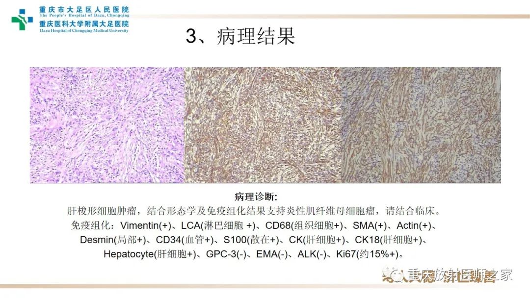 影像PPT - 【病例】肝脏炎性肌纤维母细胞瘤1例CT及MR-7