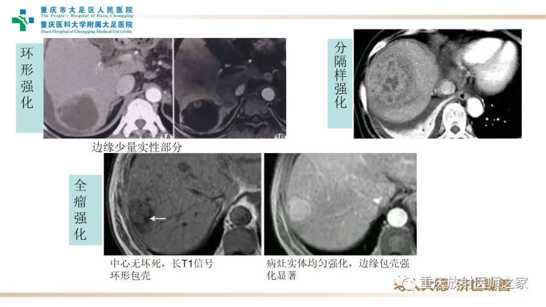 影像PPT - 【病例】肝脏炎性肌纤维母细胞瘤1例CT及MR-11