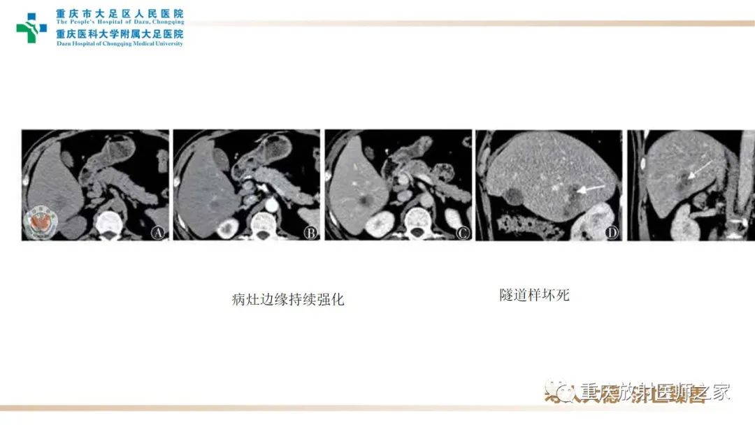 影像PPT - 【病例】肝脏炎性肌纤维母细胞瘤1例CT及MR-12