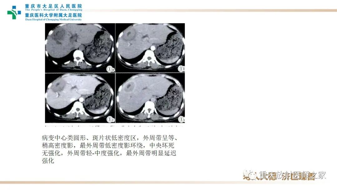 影像PPT - 【病例】肝脏炎性肌纤维母细胞瘤1例CT及MR-13