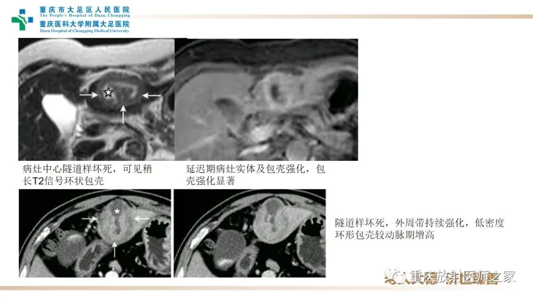 影像PPT - 【病例】肝脏炎性肌纤维母细胞瘤1例CT及MR-14