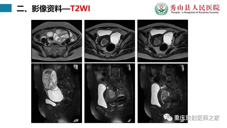 影像PPT - 【病例】子宫内膜样癌1例MR影像-3