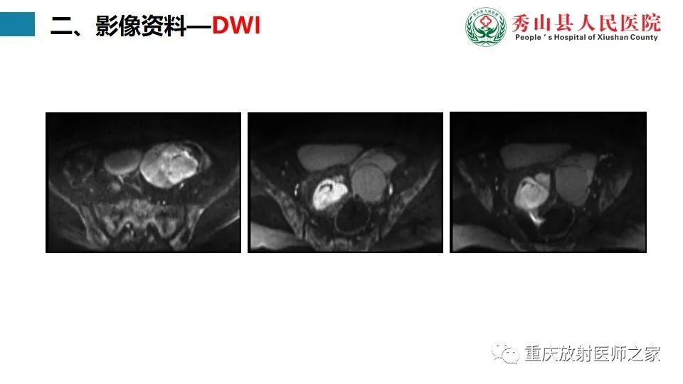 影像PPT - 【病例】子宫内膜样癌1例MR影像-5