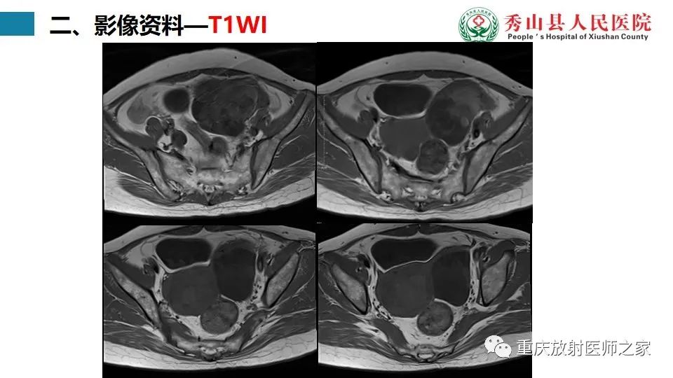 影像PPT - 【病例】子宫内膜样癌1例MR影像-4