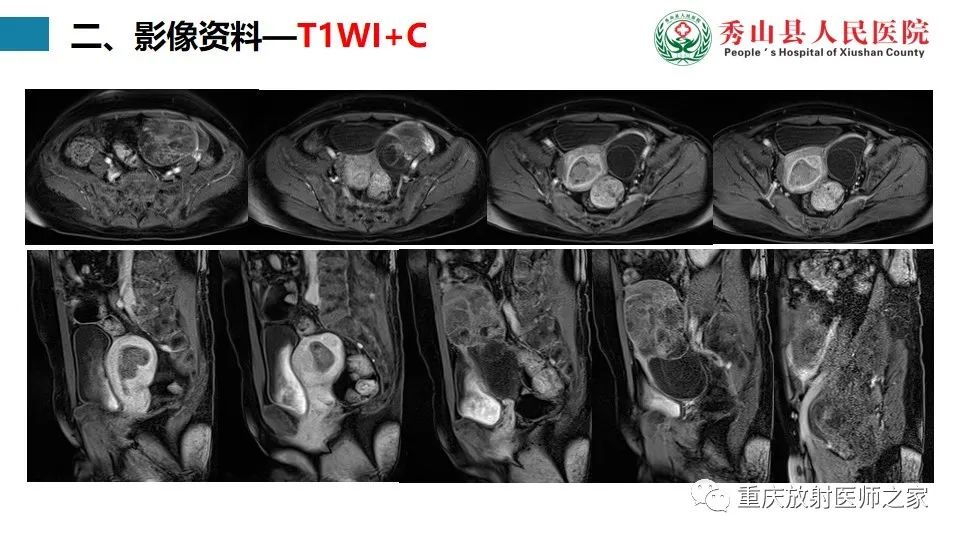 影像PPT - 【病例】子宫内膜样癌1例MR影像-6