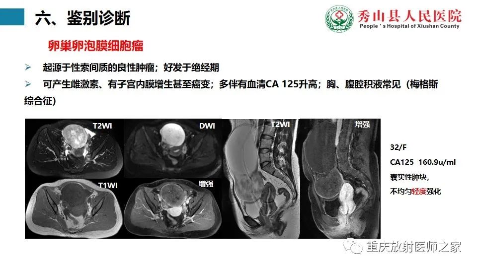 影像PPT - 【病例】子宫内膜样癌1例MR影像-13