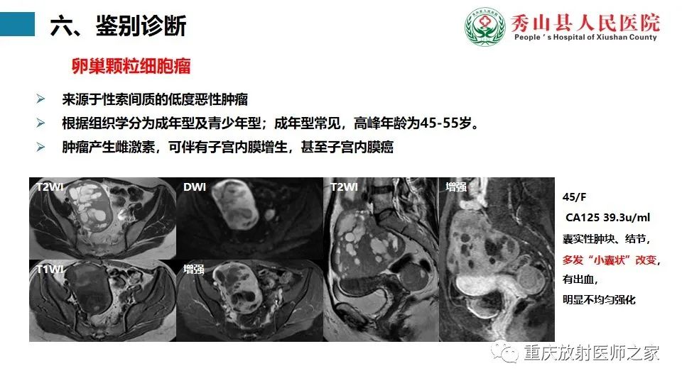 影像PPT - 【病例】子宫内膜样癌1例MR影像-12