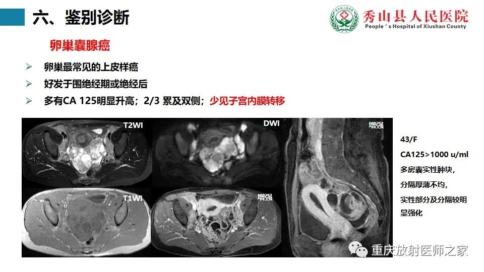 影像PPT - 【病例】子宫内膜样癌1例MR影像-11