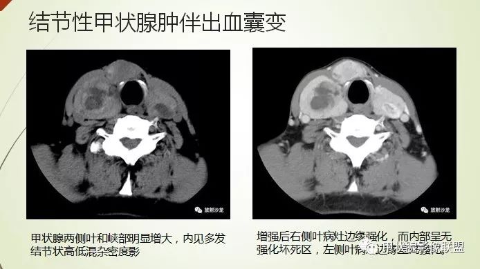 影像PPT - 甲状腺结节次要征象解读-7 影像PPT - 甲状腺结节次要征象解读-7
