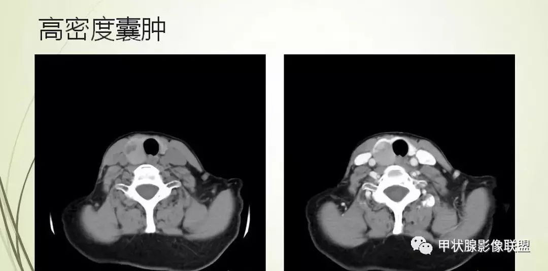 影像PPT - 甲状腺结节次要征象解读-9 影像PPT - 甲状腺结节次要征象解读-9