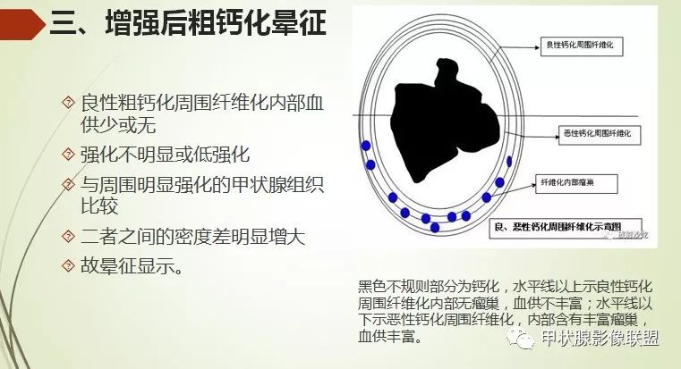 影像PPT - 甲状腺结节次要征象解读-10 影像PPT - 甲状腺结节次要征象解读-10