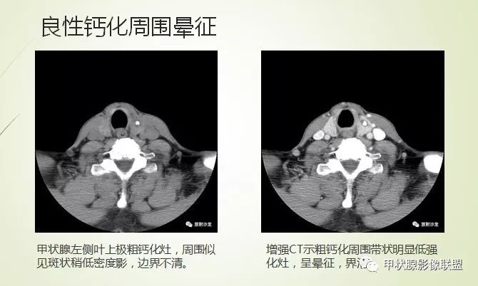 影像PPT - 甲状腺结节次要征象解读-11 影像PPT - 甲状腺结节次要征象解读-11