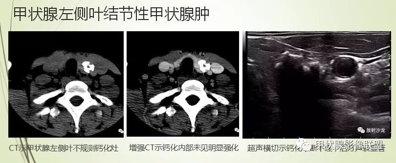 影像PPT - 甲状腺结节次要征象解读-12 影像PPT - 甲状腺结节次要征象解读-12