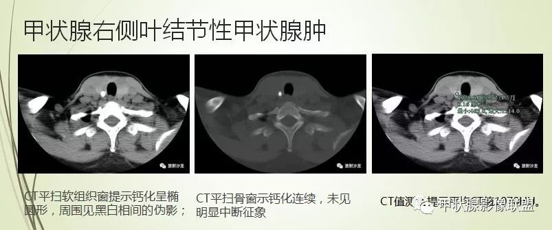 影像PPT - 甲状腺结节次要征象解读-14 影像PPT - 甲状腺结节次要征象解读-14